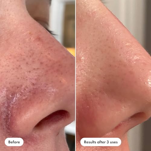 Hero Cosmetics Pore Release Blackhead Clearing Solution, Exfoliating 2% Salicylic Acid Toner Featuring AHA, BHA, and PHA, Blackhead Remover Toner, 100 ml - Image 6