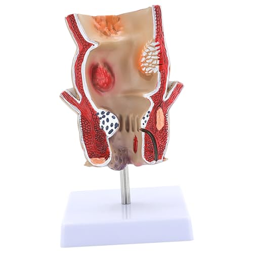 Modèle rectum humain outil d'enseignement pour pathologies et école
