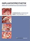  DVD-Kompendium Implantatprothetik Band 1-4: Vier Teams - Ihre Konzepte und Lösungen
