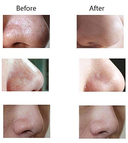 Vyoma Blackhead Remover, Pimple Sucker, Acne Nose Skin and Facial Cleanser Electric Vacuum Pore Microdermabrasion Machine Device 1