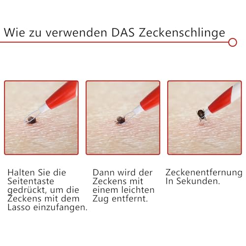Qaziuy Zeckenschlinge, Zeckenschlinge Hund mit Lupe, Schnelle Zeckenentfernung Zeckenzange für Hund, Katzen, Mensch