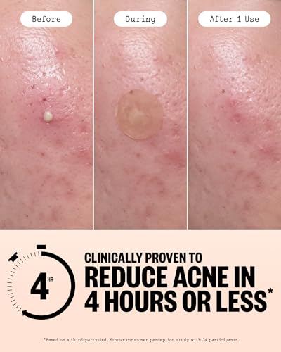 PEACE OUT Acne Healing Dots Hydrocolloid Pimple Patches (60 count) — view 3