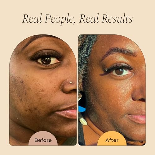 Image of Glo Melanin Organic Turmeric Soap for Dark Spots [2pack], Soap for Face, All Natural Face Wash