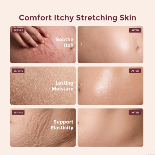 Image of Momcozy Pregnancy Stretch Mark Prevention Cream Travel Belly Lotion 1.06 oz | EWG Verified, Dermatologist Tested, 4x Pro Collagen Peptides and Centella Asiatica Deeply Hydrate & Restore Elasticity