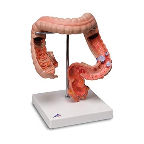 3B Scientific - 1008496 K55 Intestinal Diseases - 3B Smart Anatomy Cover