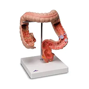 3B Scientific - 1008496 K55 Intestinal Diseases - 3B Smart Anatomy