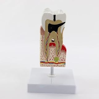 Decay Tooth Model, Human Body Anatomy Replica of Teeth, Teeth Model for Patient Education and Pathological Display