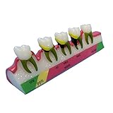 Periodontitis Periodontal Disease Classification Model - Dental Teeth Model - Teeth Study Teaching Model Adult Standard Demonstration Tooth Model for Education