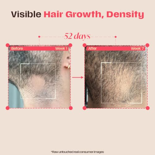 Image of Days Ahead Leave-in Hair Growth Ampoule Serum (Roll on) | 16% Growth Actives | PDRN, Redensyl, Anagain | Hair Growth Serum | Promotes Growth, Increases Density | Non-Greasy | For Women & Men | 25 ml