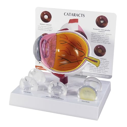 Human Cataract Eye Anatomical Model