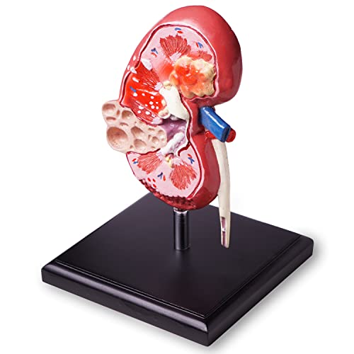 Image of Human Kidney Model ✮ Premium Quality ✮ Anatomical Model To Demonstrate Normal Kidney ✮ And ✮ Diseased Kidney with Pathologies ✮