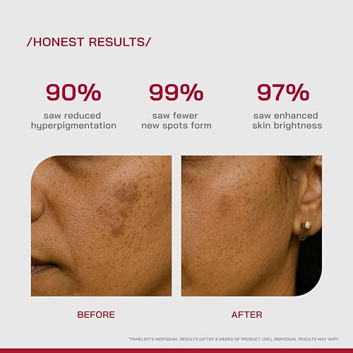 Image of /PHD / 2% Alpha Arbutin Depigmentation Serum | Alpha Arbutin for Pigmentation & Dark Spot | Pigmentation serum for Women & Men | Tyrobright, Niacinamide | Tan removal | Fragrance-Free | 10ml