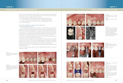 Rimodellamento Osseo Perimplantare. Background Scientifico E Implicazioni Cliniche - 3