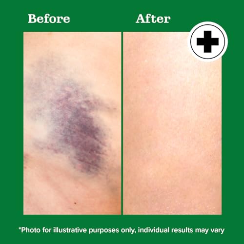 Miracle Plus Natural Arnica Bruise Body Gel | Arnica Montana Lotion For Thin Skin Bruising And Swelling After Surgery | Extra Strength Vitamin K Cream | Skin Care Arnica Ointment For Bruises, 4 Oz - Thumbnail 6