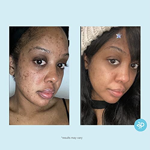 Salicylic 10% Gel Peel, Breakout And Pore Minimizer And Cleanser, 15-30 Full Facial Chemical Peels, 1 Fl Oz. E, 30 Ml – Perfect Image #TOP4