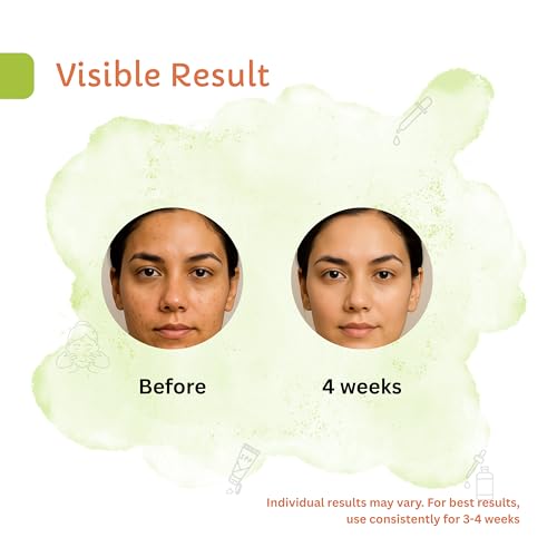 Image of ZBEE 15% Vitamin C Face Serum for Glowing Skin with Hyaluronic Acid & Pro Vitamin B5 - Anti Pigmentation & Dark Spot Removal Serum for Men & Women - 30ml