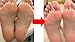 Award-Winning Foot Peeling Mask - Dr. Pedicure Foot Peel Masks (4 Pairs, Coconut) - Moisturizing Foot Masks That Remove Dead Skin, Exfoliating Foot Mask for Dry Cracked Feet, Feet Peeling Mask