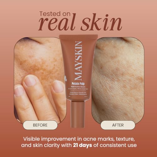 Image of Potato Pulp Multi-Active Serum - Glycolic Acid, Arbutin & Vitamin C for Acne Marks, Dark Spots & PIH | Prebiotics & Barrier Support | Fragrance-Free | For All Skin Types | 30ml