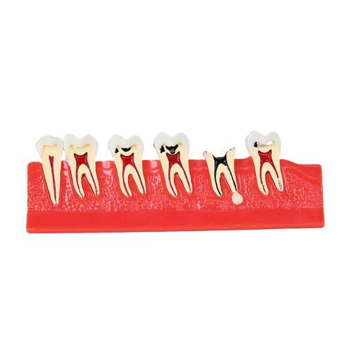 Buy Dental Caries Model Anatomy Teeth Model Development of Caries