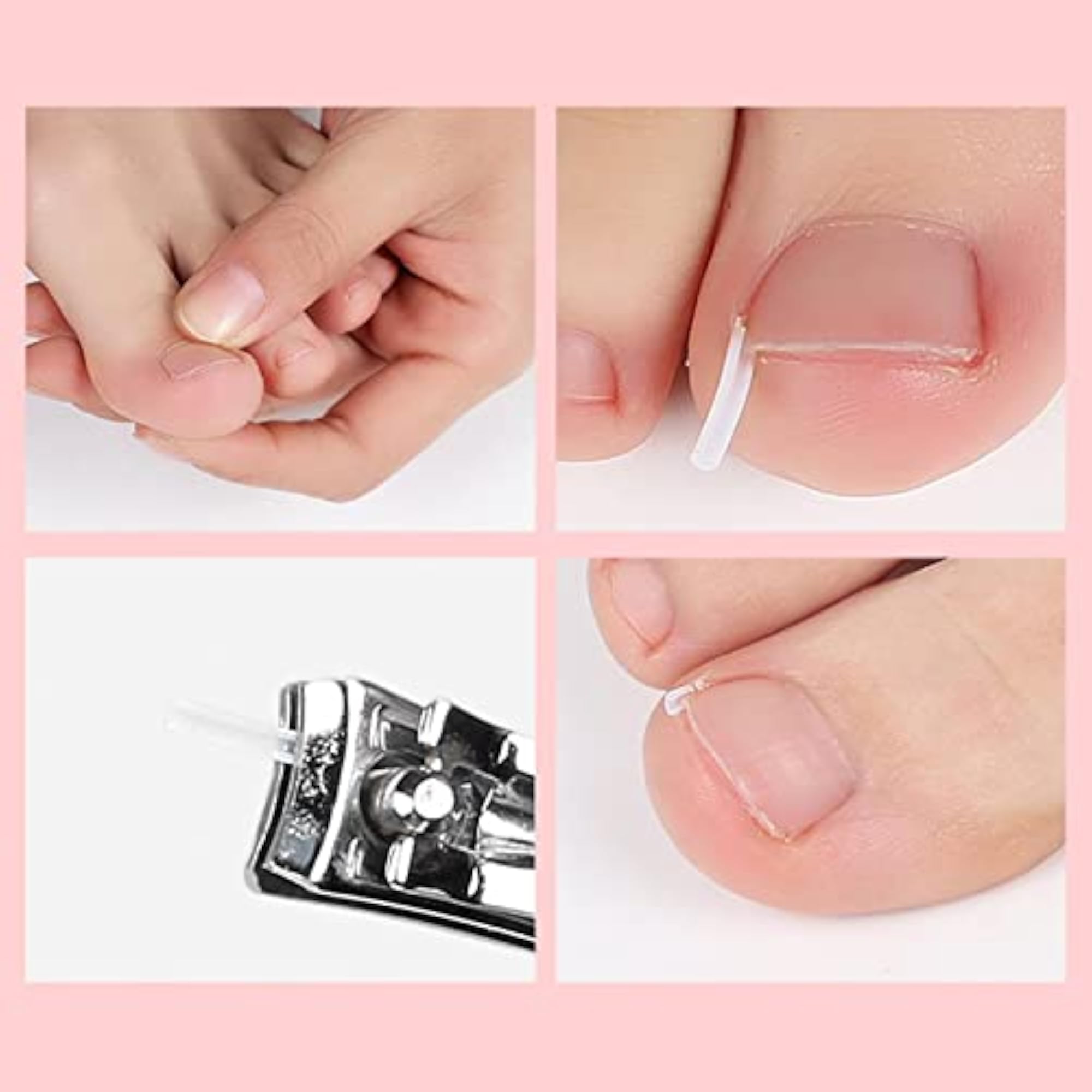 6x Ingrown Toenail Correction Tool, Foot Care