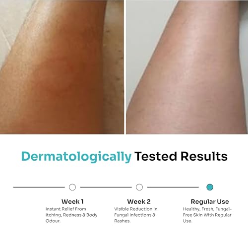 Image of Kitcoz Anti-Fungal Body Wash with Tea Tree Oil | For Itchy, Uncomfortable & Irritation-Prone Skin | Paraben Free for Men & Women (300ml)