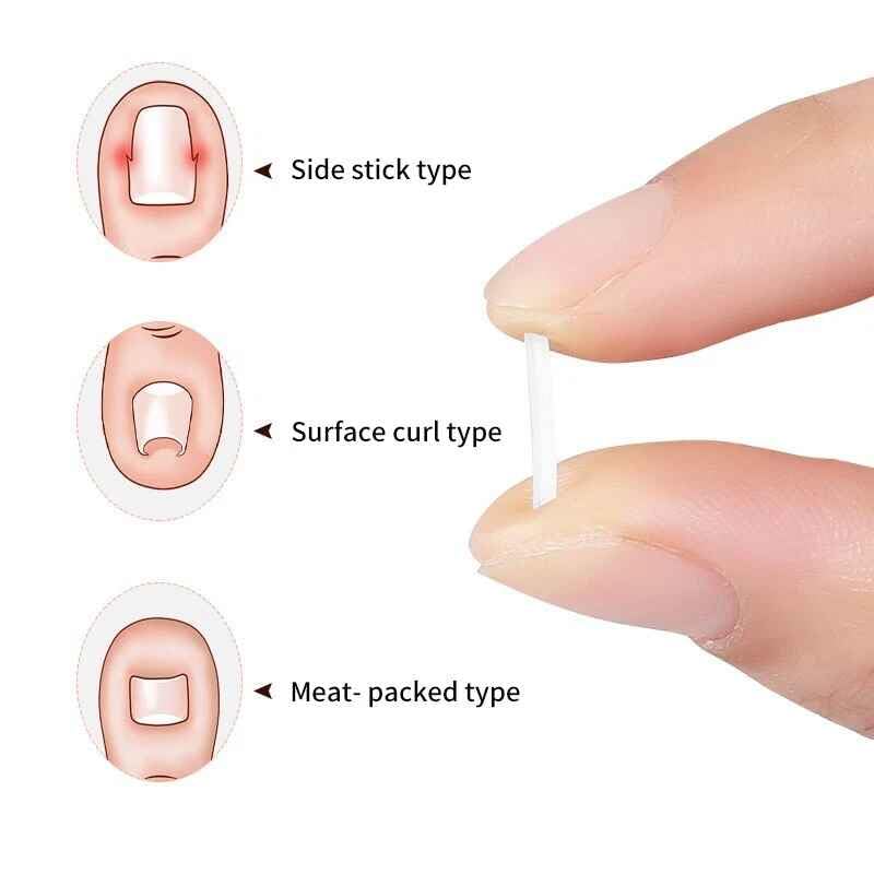 20Pcs Ingrown Toenail Correction Strips Brace Kit,Ingrown Toenail Corrector Straightener Strips Recover Clips Toenails Thick Pedicure Tool Toenail Straightener Strip