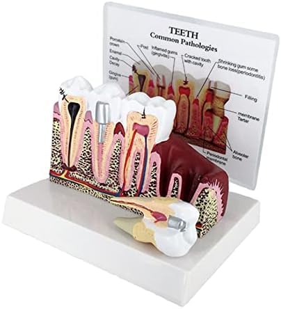 Model Zębów Próchnicy, Model Zębów Dentystycznych Do Badania Anatomii Zębów Dentystycznych, Edukacji Lekarza-pacjenta I Higieny Jamy Ustnej,Serene16