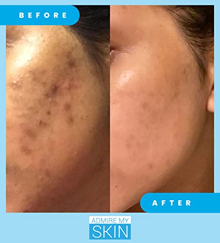 Admire My Skin Dark Spot Corrector Remover For Face - Brightening Discoloration Correcting Serum - Melasma Treatment Cream With Synovea, Kojic Acid, Vitamin C, Salicylic Acid, Lactic Acid Serum #TOP6