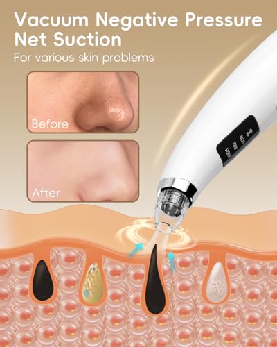 FLYMOOO Rechargeable Blackhead Vacuum Pore Cleaner - 5 Attachments & 3 Suction Levels for Deep Facial Cleansing, USB-Powered Blackhead Remover for Women and Men (White)