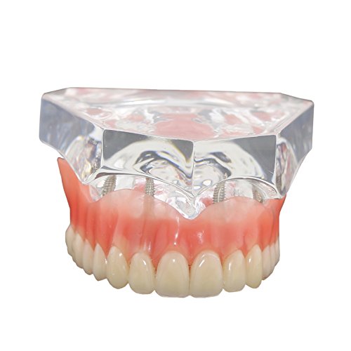Dental Model Teeth Implant Restoration Demo 4 Implants Upper Teeth Bridging Dentures Modelfor Teaching Studying (6001 clear)