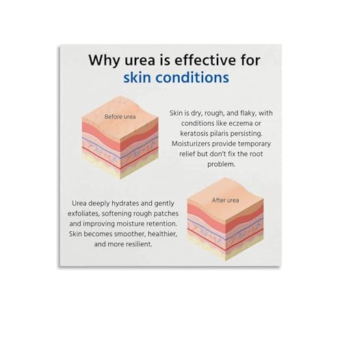 How Urea Is Effective for Skin Conditions Poster Eczema Keratosis