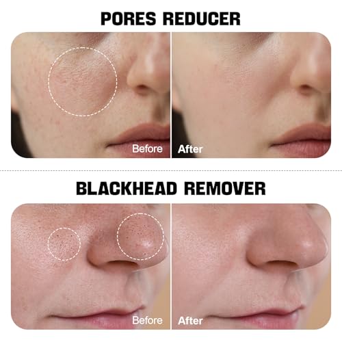 Salicylic-Acid-Toner-BHA-Toner-Niacinamide-Toner-Potent-Blackhead-Remover-Face-Exfoliator-Zealsea-Gentle-Pore-Minimizer-for-Face-BHA-Liquid-Exfoliant-for-Sensitive-Skin-Alcohol-Free-676-OZ