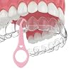 Clear aligner removal tool-invisible removable braces, invisible aligner remover-aligner remover-fixer remover (40pcs)