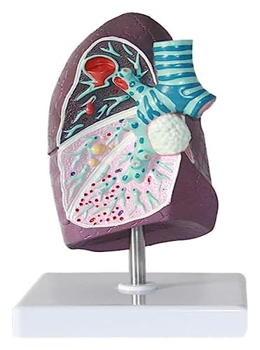 Modelo de cáncer de pulmón 2:3 para estudios e investigaciones médicas 2