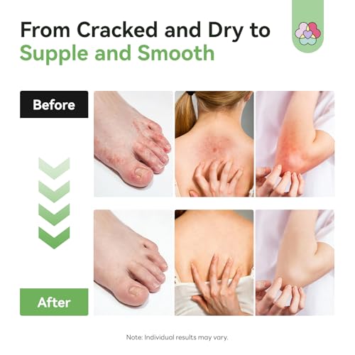 Image of SAVILAND Antifungal Cream 120g Extra Strength: Max 25% Undecylenic Acid Fungal Cream for Skin Athletes Foot Jock Itch Ringworm Foot Fungus Treatment Natural Skin Relief with Tea Tree & Oregano Oil