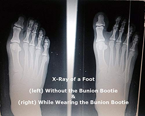 Bunion Bootie Ultra-Thin Bunion Corrector - Orthopedic Bunion Splint for Non-Surgical Hallux Valgus Correction - Big Toe Straightener & Hammer Toe Corrector - Bunion Guard & Sleeve - Medium-Right - Thumbnail 4