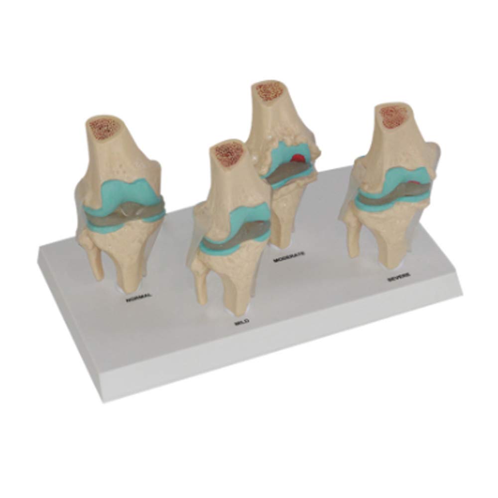 Buy Educational Model Human Knee Joint Model Set Anatomy 4Stage Knee