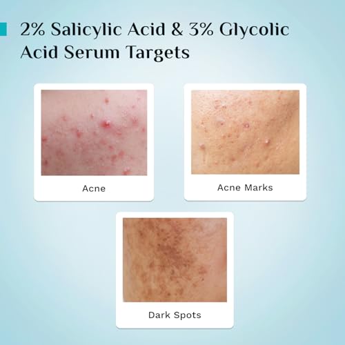 Image of Pilgrim Salicylic Acid 2% + Glycolic Acid 3% Anti Acne Serum For Acne Prone Skin For Unisex Of All Skin Types, Korean Skin Care, 30ml