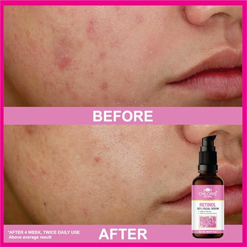 Image of Retinol Face Serum for Anti-Aging 30ml | Retinol (Vitamin A) Serum | Reduces Wrinkles, Fine Lines & Dark Spots | Boosts Collagen | Dermatologically Tested | Men & Women