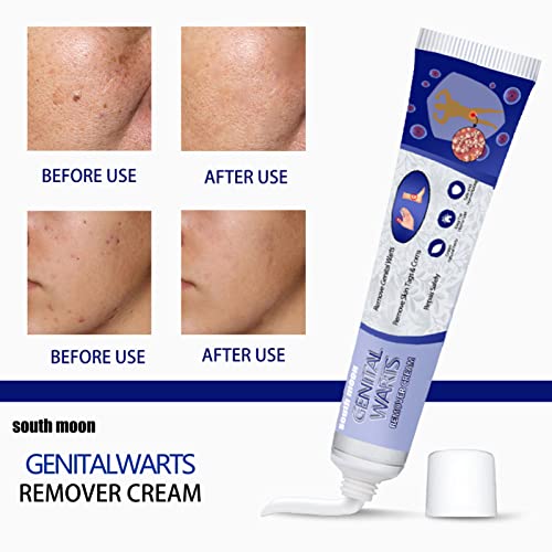 Miaoao SOUTH MOON 20g Verrugas Genitais Remover Pomada Removedor de Etiqueta de Pele Ingredientes de