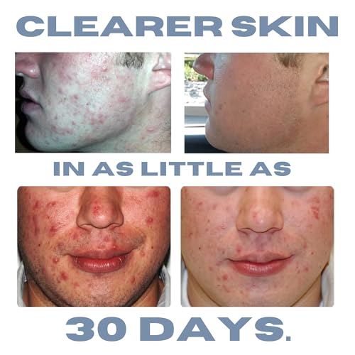 Clearogen Hormonal Acne Solution Natural Anti-DHT Ingredients Formula Benzoyl Peroxide, 1 Month Original Benzoyl Kit