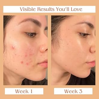 Auravedic Kumkumadi Oil For Face 100 Ml, Kumkumadi Tailam Face Oil For Glowing Skin, Dark Spot Corrector Face Serum