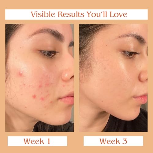 Auravedic Kumkumadi Oil For Face 100 Ml, Kumkumadi Tailam Face Oil For Glowing Skin, Dark Spot Corrector Face Serum