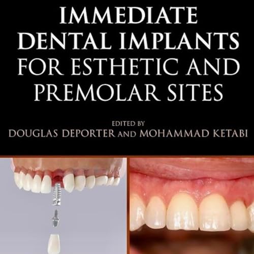 Immediate Dental Implants for Esthetic and Premolar Sites