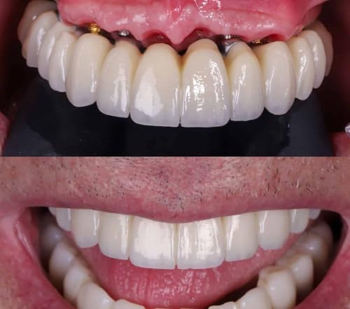 Everything You Need to Know About Full Mouth Dental Implants