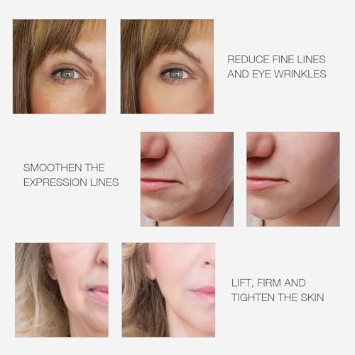 MLAY Radio Frequency Skin Tightening Device