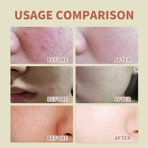 Beef Tallow for Skin, Tallow and Honey Balm, Grass Fed Beef Tallow for Skin Care - Natural Handmade Lotion Whipped Bee Venom Cream for Face & Body Sensitive Skin