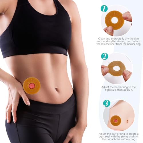 30 peças de anéis de barreira de ostomia adaptáveis, extensores de pele hidrocolóide moldáveis finos