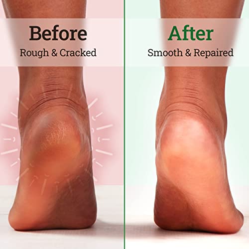 Tea Tree Oil Foot Soak With Epsom Salt & Mint, Feet Soak Helps Toenail System, Athletes Foot & Stubborn Foot Odor - Foot Bath Salt Softens Calluses & Soothes Sore Tired Feet, 14 Ounce #TOP5