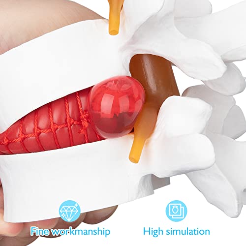 Image of ANNWAN Disc Herniation Model - Human Lumbar Disc Herniation Spine Model Vertebrae Disc Model for Teaching and Studying